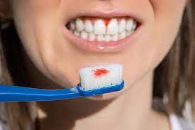 Should I continue brushing if my gums bleed?