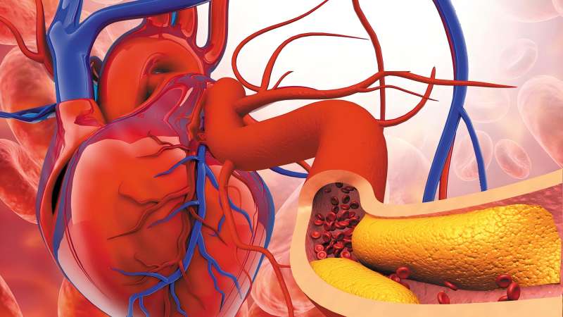 The Connection Between High Cholesterol and Heart Disease