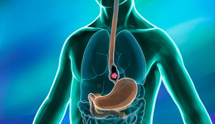 How to spot early signs of esophageal cancer?