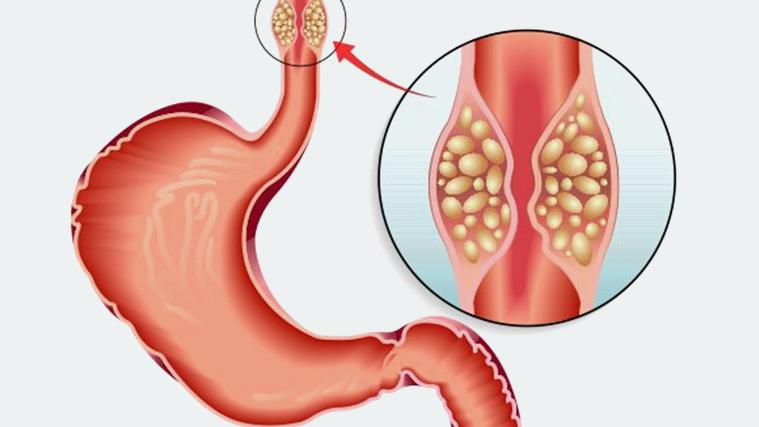 The Link Between Acid Reflux And Esophageal Cancer